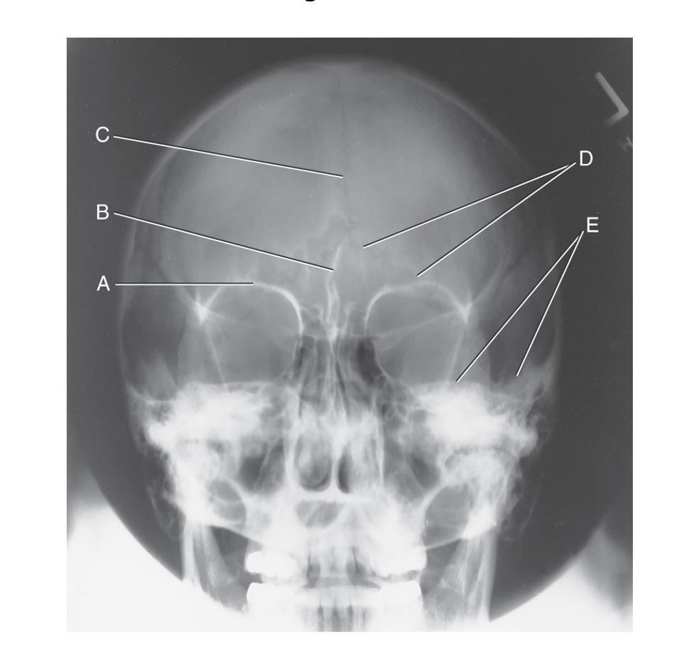Caldwell method figure Diagram Quizlet