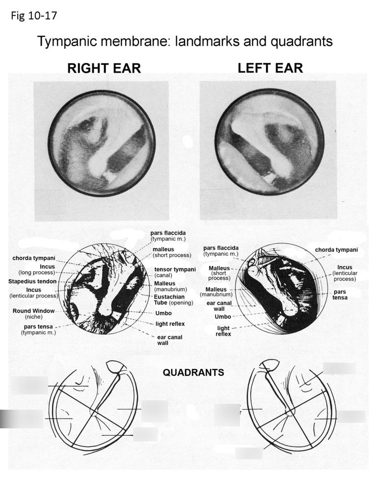1017 Tympanic membrane landmarks and quadrants Diagram Quizlet