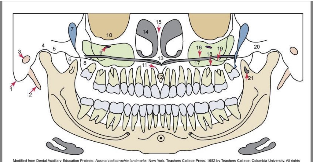 Anatomic landmarks of maxilla in pano Diagram Quizlet