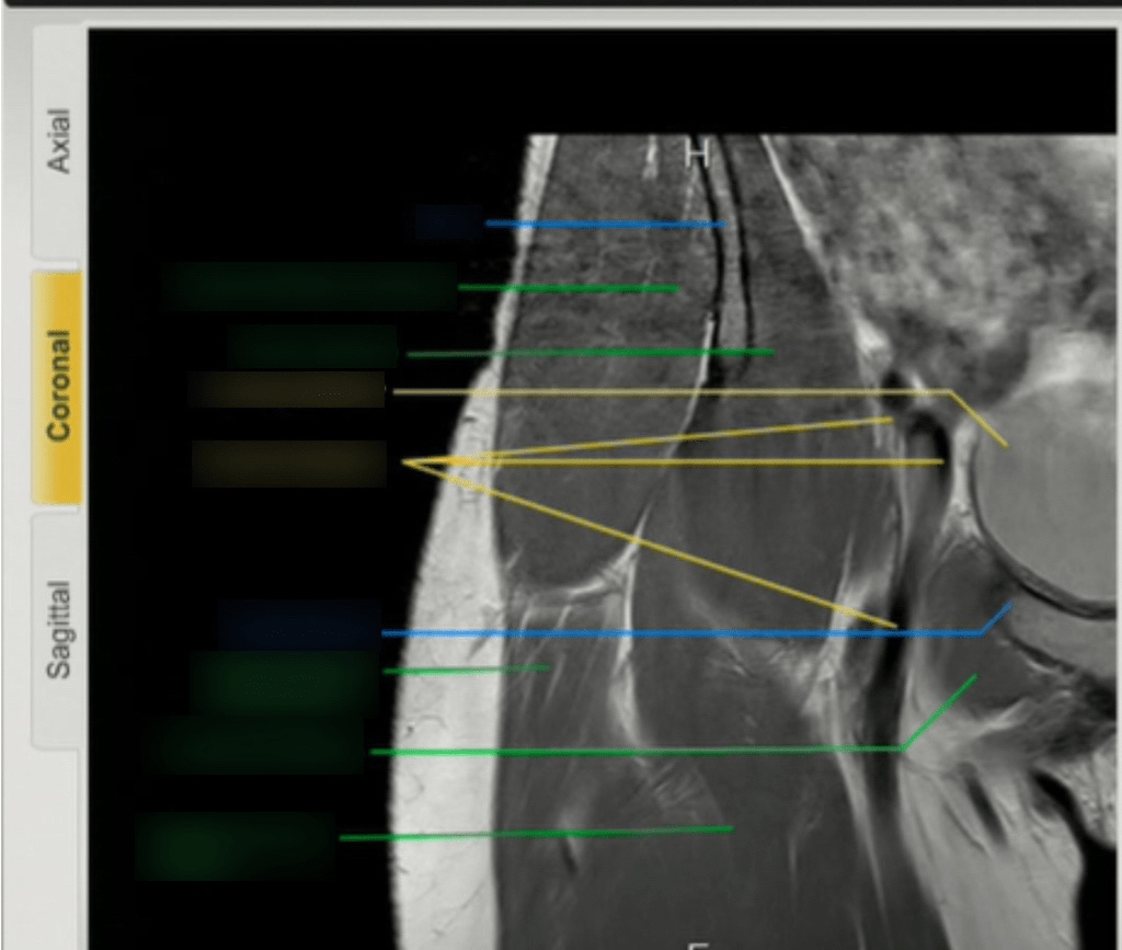 Coronal Hip MRI 1 Diagram Quizlet