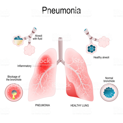 M3 Clin Med Pneumonia, Acute Bronchitis, Bronchiectasis, Cystic