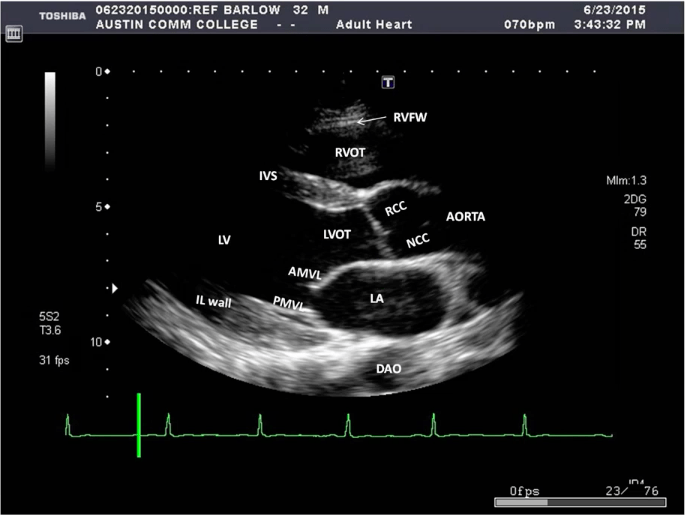 Unit 2 Introduction to Transthoracic Echocardiogram (TTE) Diagram