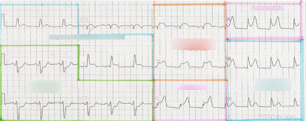 Label that ECG! Diagram | Quizlet