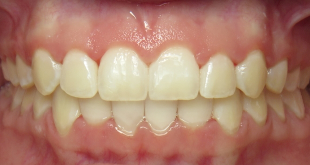 Correct Your Bite Invisalign Clear Aligners & Braces