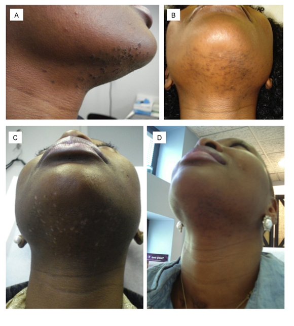 Laser Hair Removal Cost Chin Prices For Permanent Hair Removal
