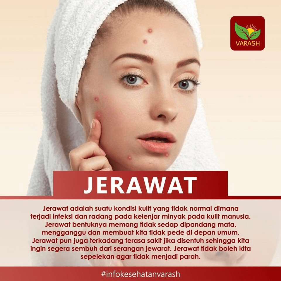 Cara Menghilangkan Jerawat Varash (+628121737190)