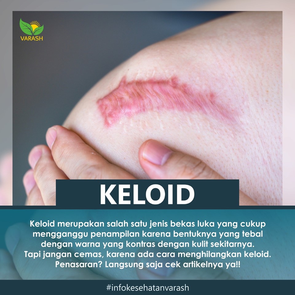 APA ITU KELOID? Varash Malang (+628121737190)