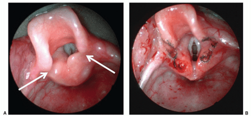 Surgical Care of Conditions Presenting in the Newborn Obgyn Key