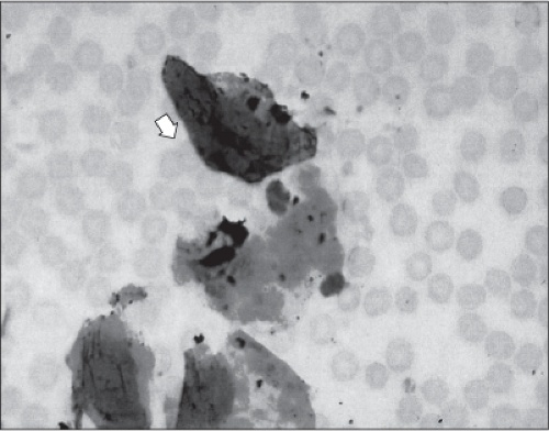 Amniotic Fluid Embolus (Anaphylactoid Syndrome of Pregnancy) Obgyn Key