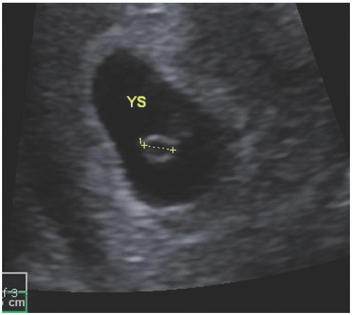 Point-of-Care Sonography in the First Trimester | Obgyn Key