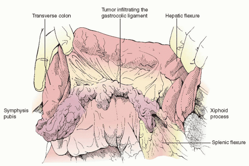 Cytoreductive Surgery for Ovarian Cancer Upper Abdominal Procedures Obgyn Key