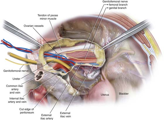 Identifying and Avoiding Ureteral Injury Obgyn Key
