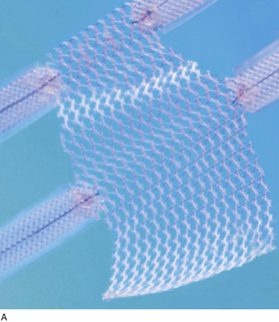 TrocarBased Synthetic Mesh Kits Used to Correct Pelvic Organ Prolapse