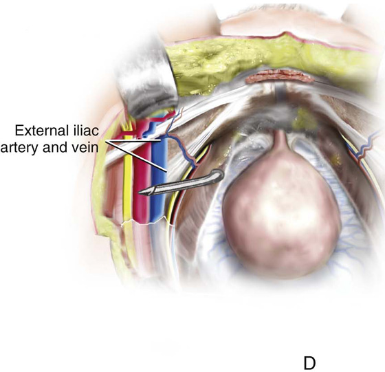 Synthetic Midurethral Slings for the Correction of Stress Incontinence Obgyn Key