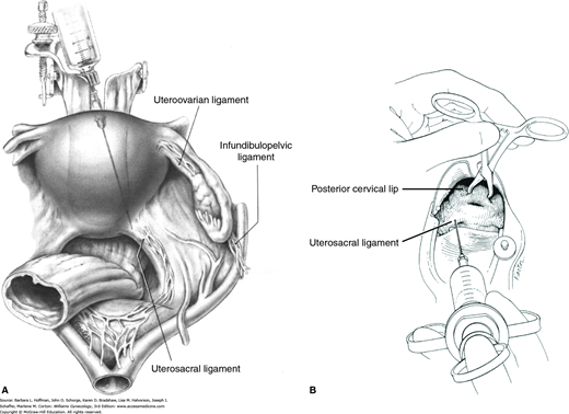 CHAPTER 40 Intraoperative Considerations Obgyn Key