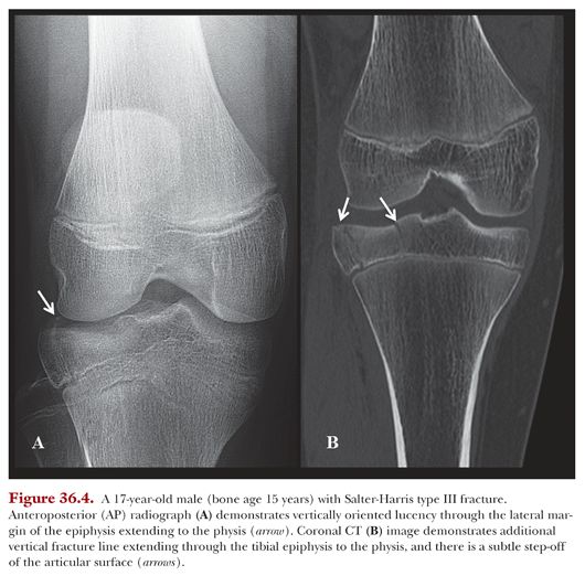 Epiphyseal Fracture X Ray