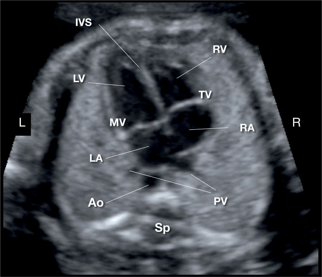 Cardiac Chambers The FourChamber and ShortAxis Views Obgyn Key