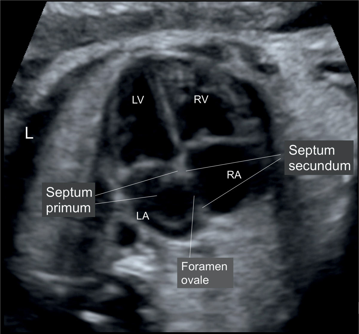 Cardiac Chambers The FourChamber and ShortAxis Views Obgyn Key