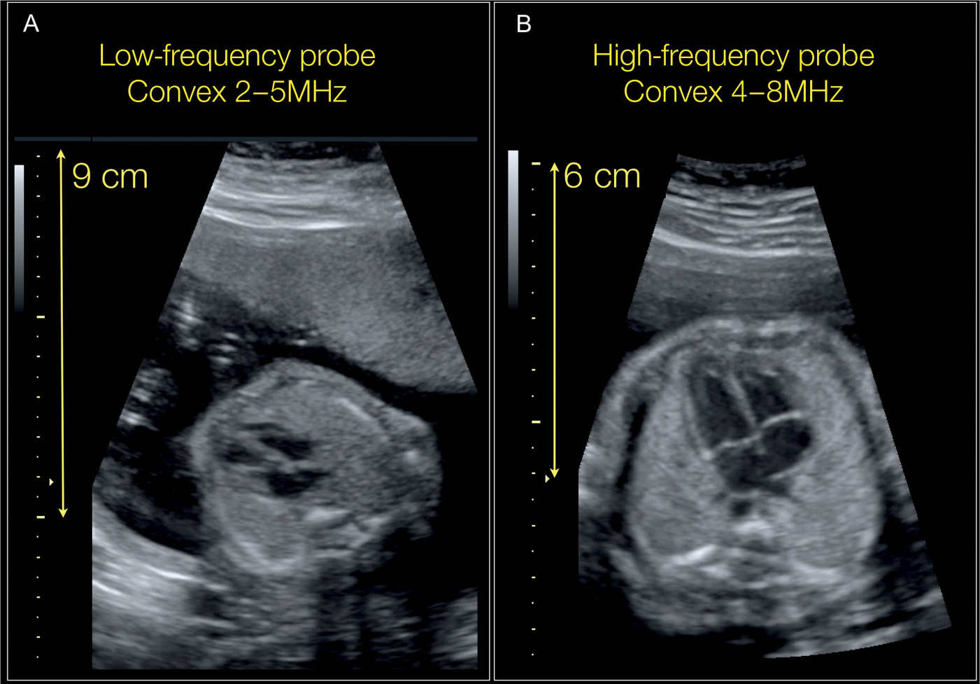 Fetal Heart Transducer at Derrick Kidd blog