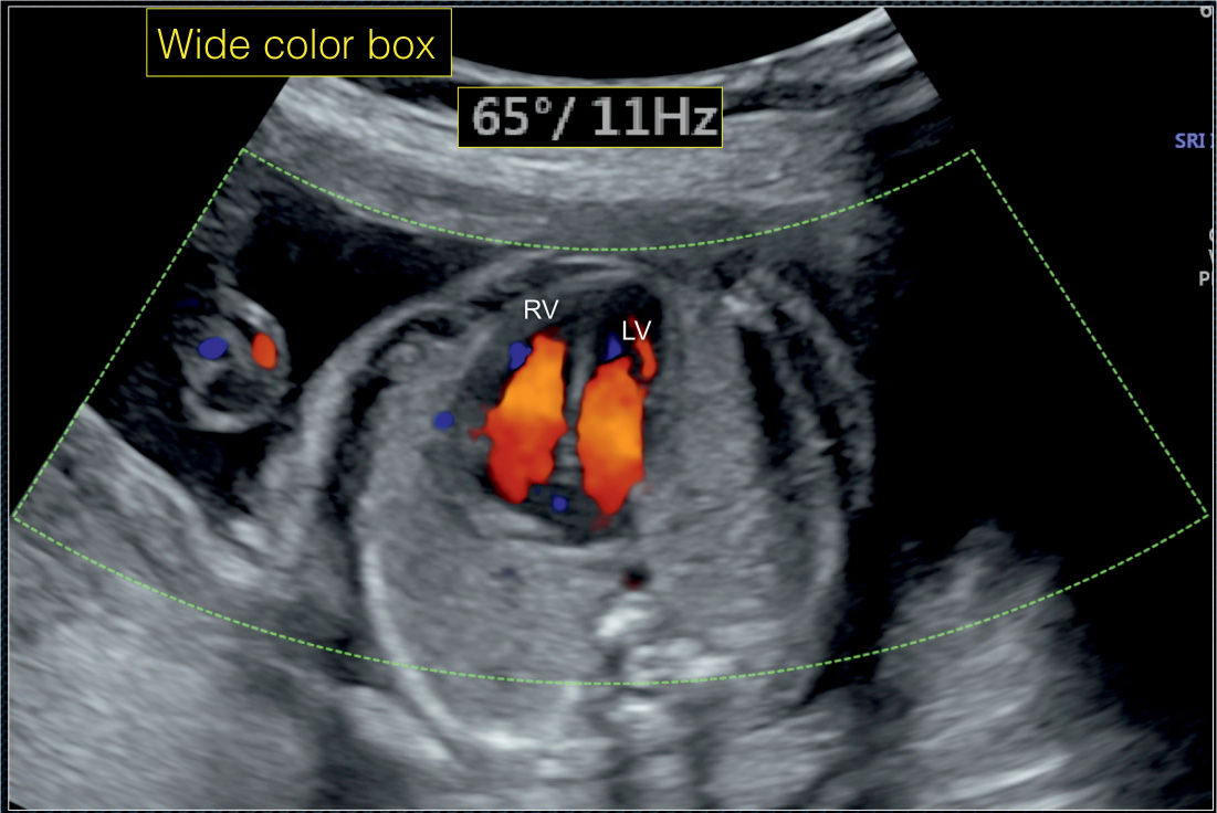 Color Doppler in Fetal Echocardiography Obgyn Key