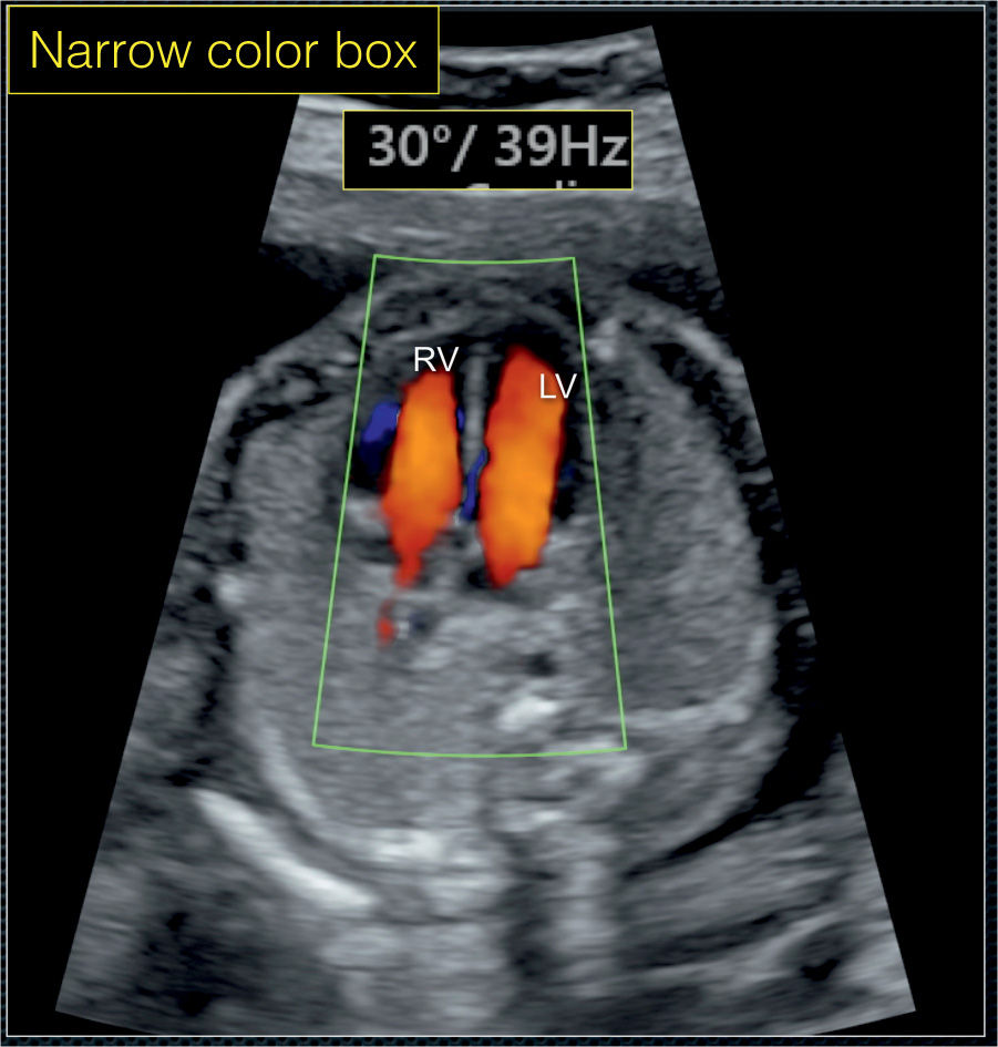 Color Doppler in Fetal Echocardiography Obgyn Key