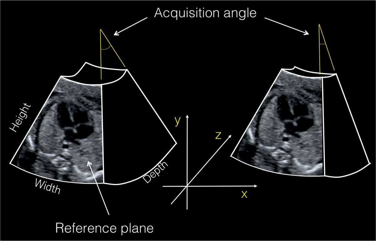 3d Ultrasound Of The Heart