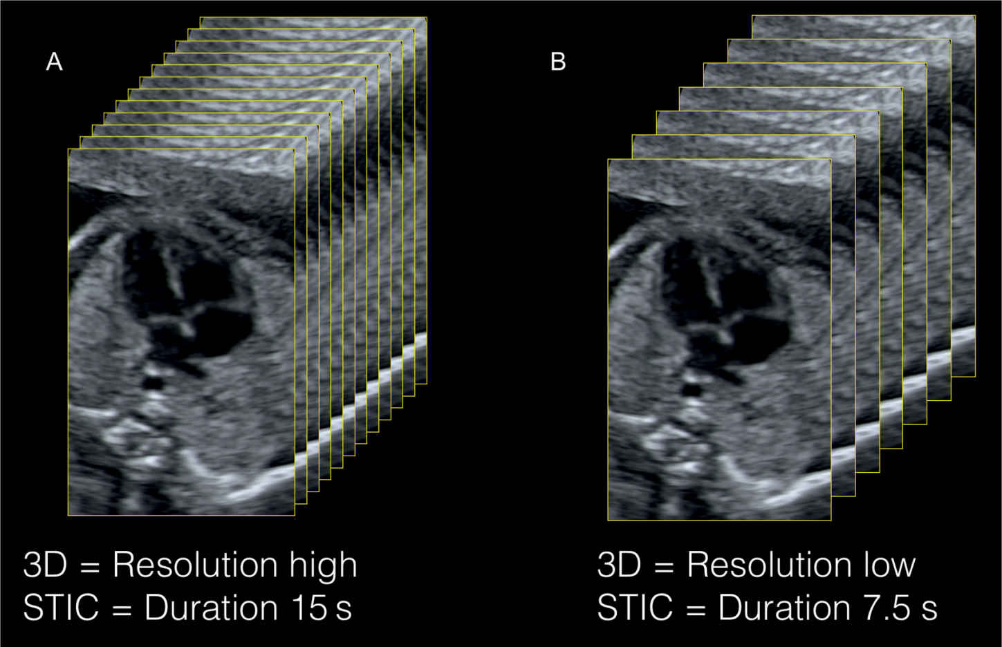 Three and FourDimensional Ultrasound of the Fetal Heart Obgyn Key