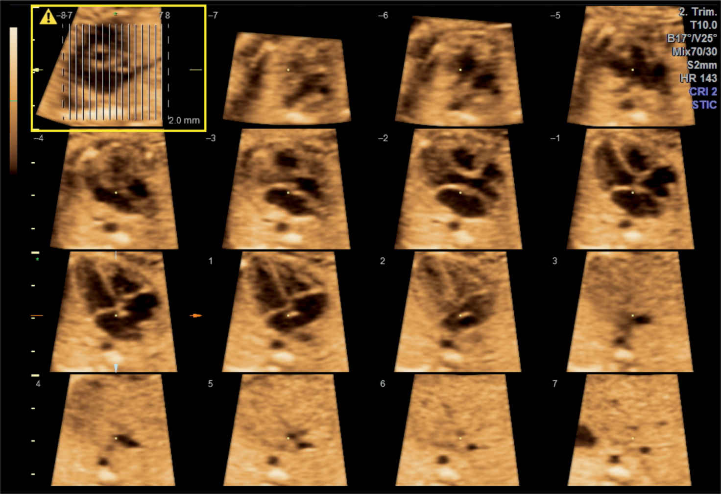 3d Ultrasound Of The Heart