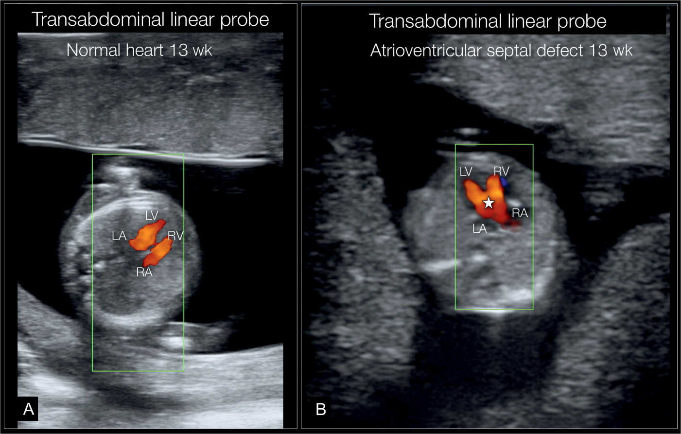 Fetal Cardiac Examination in Early Gestation Obgyn Key