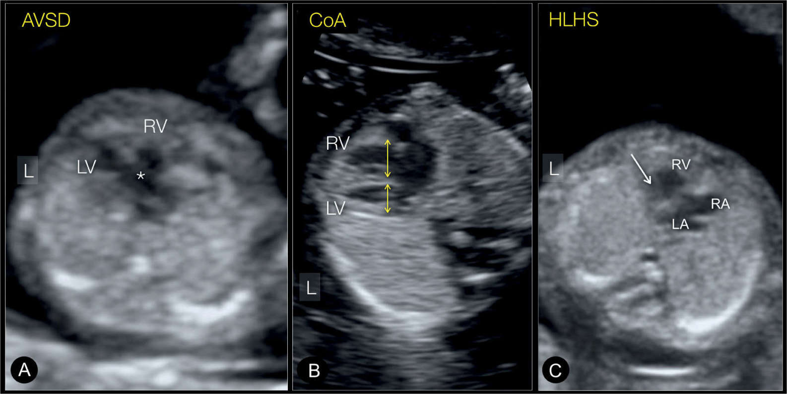 Fetal Cardiac Examination in Early Gestation Obgyn Key