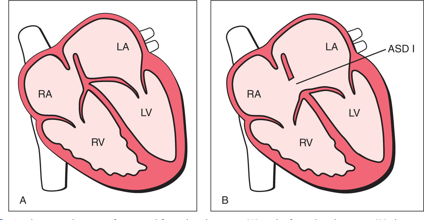 Atrial, Ventricular, and Atrioventricular Septal Defects Obgyn Key