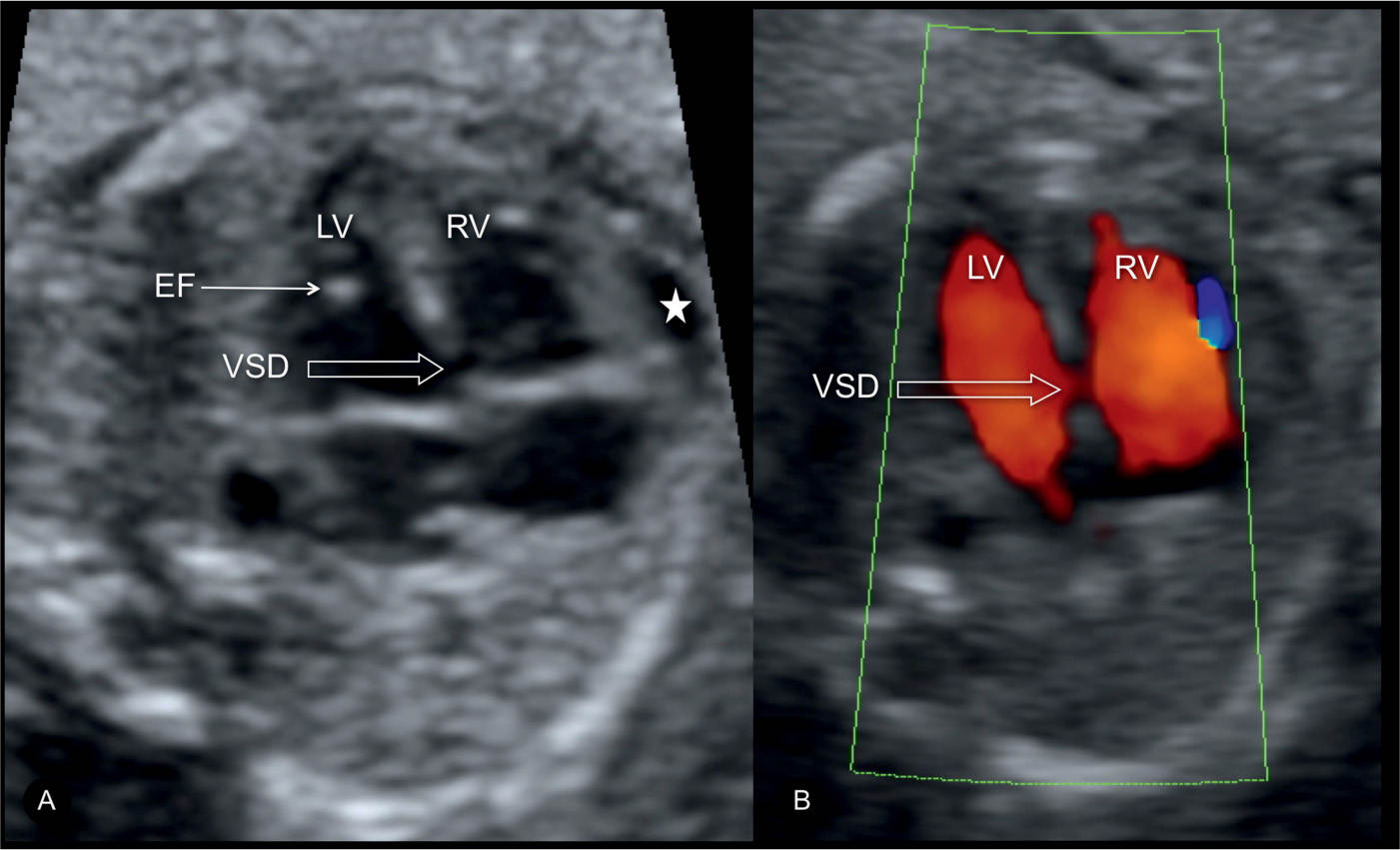 Atrial, Ventricular, and Atrioventricular Septal Defects Obgyn Key