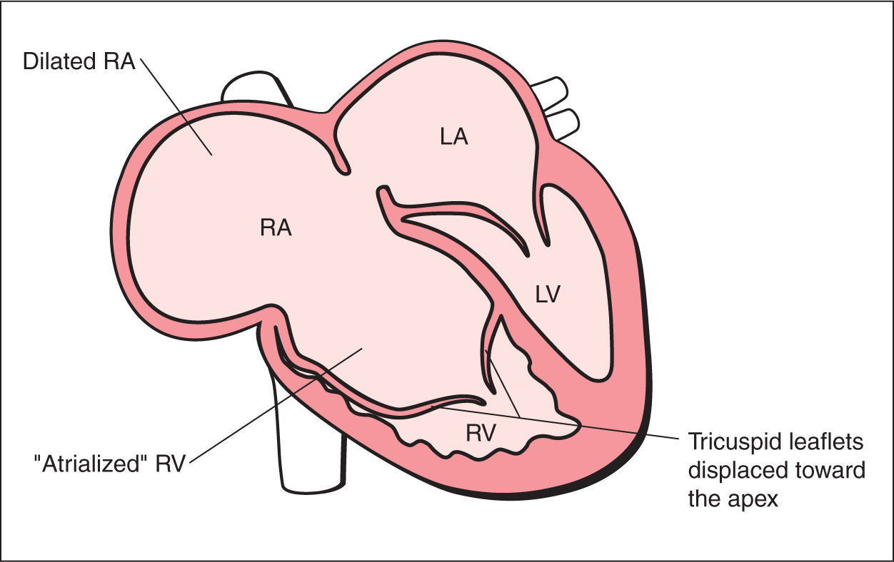 Ebstein Anomaly, Tricuspid Valve Dysplasia, and Tricuspid Regurgitation