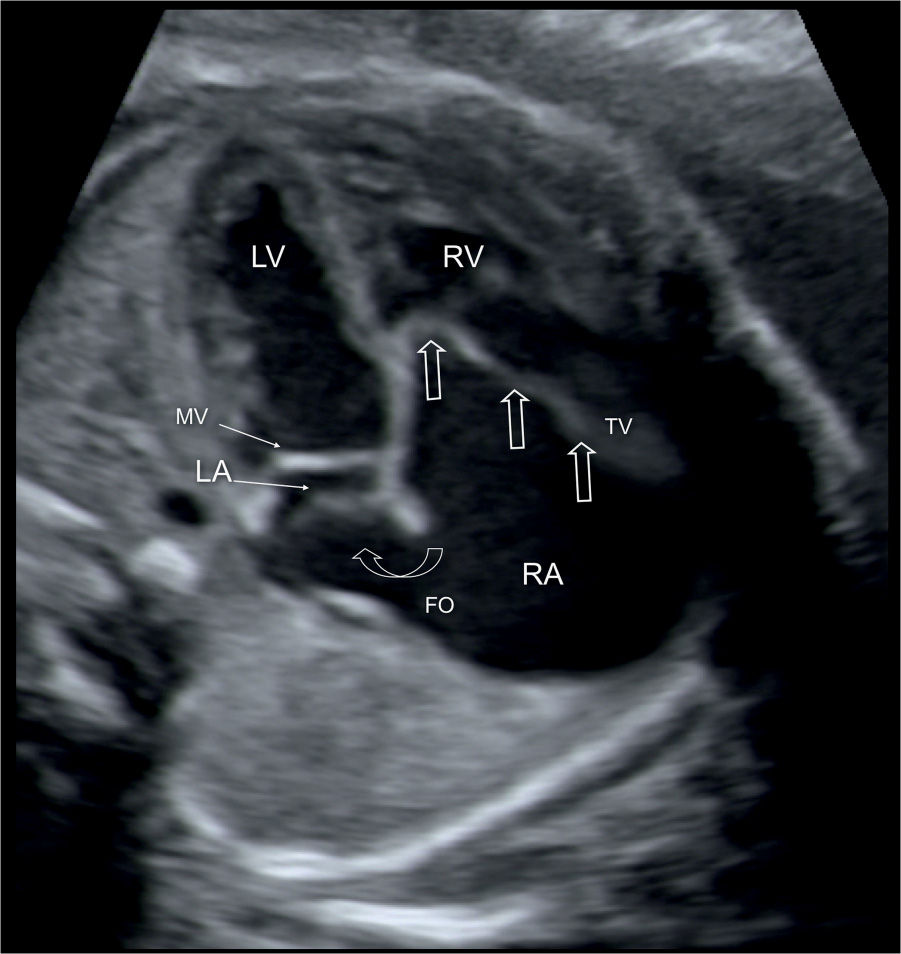 Ebstein Anomaly, Tricuspid Valve Dysplasia, and Tricuspid Regurgitation