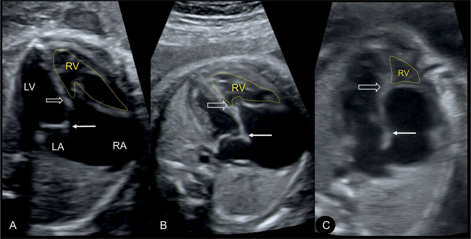 Ebstein Anomaly, Tricuspid Valve Dysplasia, and Tricuspid Regurgitation