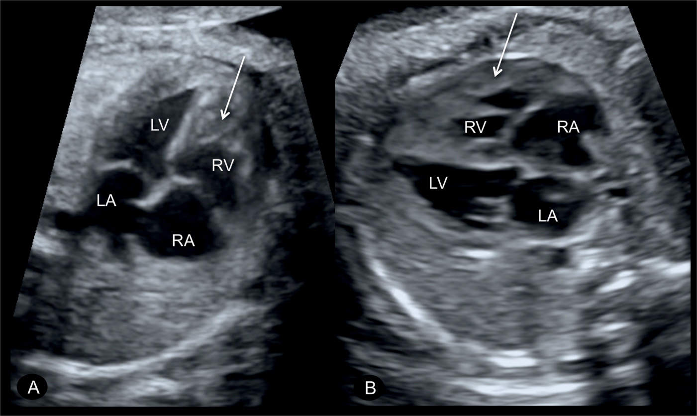 Pulmonary Stenosis, Pulmonary Atresia with Intact