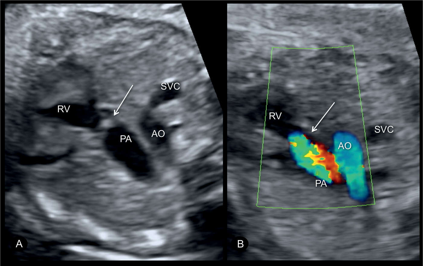 Pulmonary Stenosis, Pulmonary Atresia with Intact