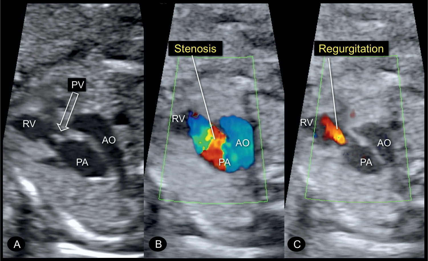 Pulmonary Stenosis, Pulmonary Atresia with Intact