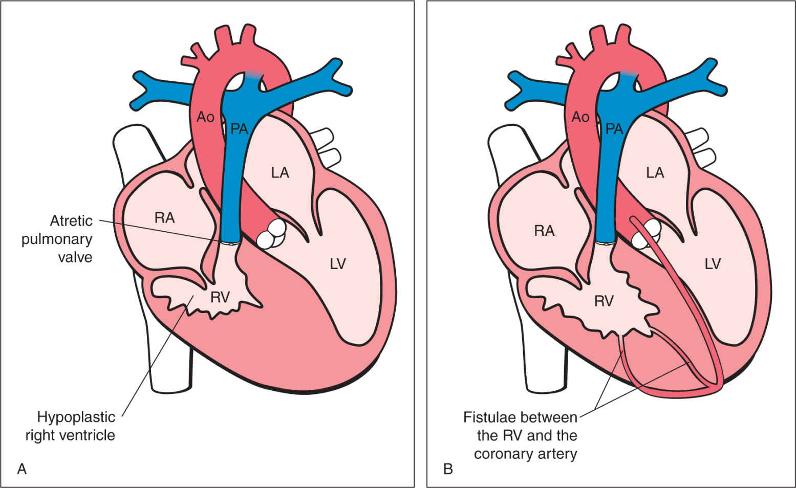 What Is Pulmonary Valve Stenosis at Sharon Cooney blog