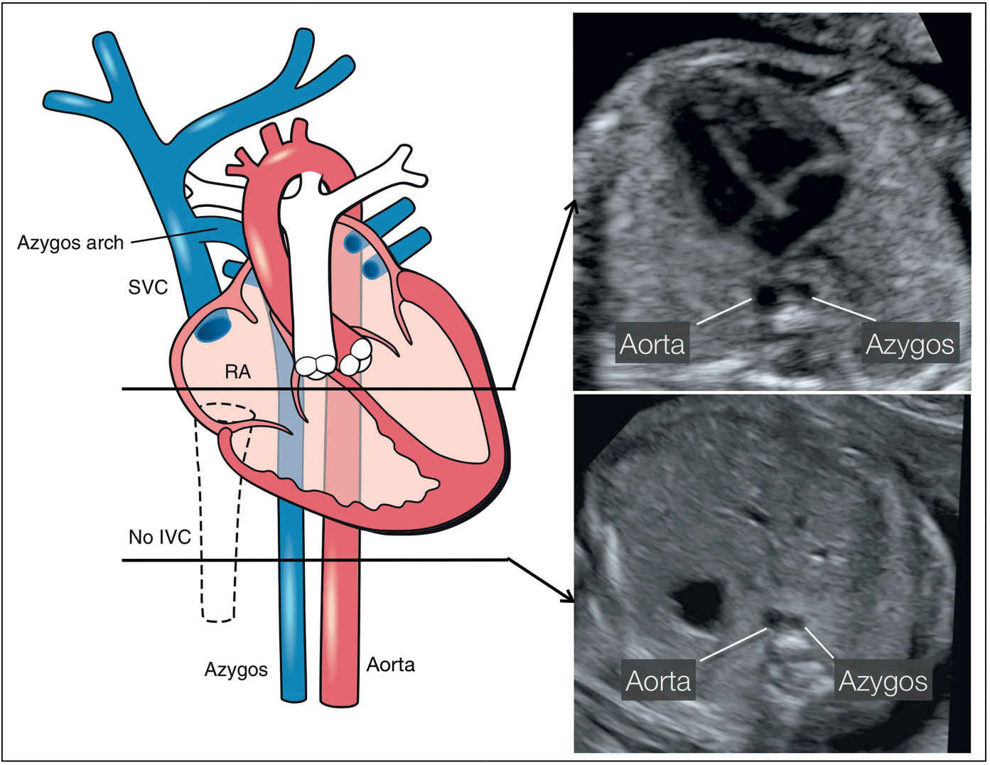 Anomalies of Systemic and Pulmonary Venous Connections Obgyn Key