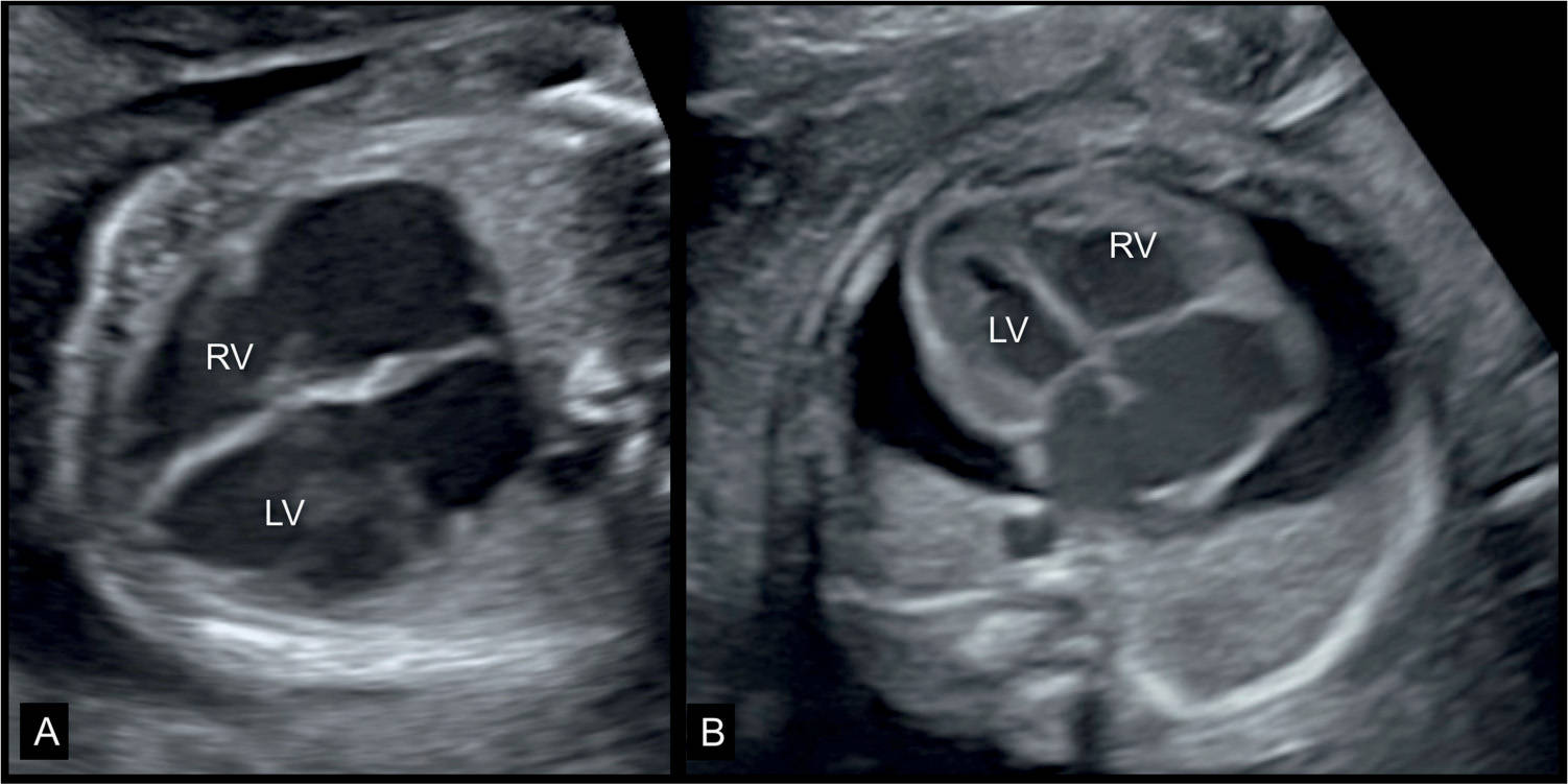 Fetal Cardiomyopathies and Fetal Heart Tumors Obgyn Key