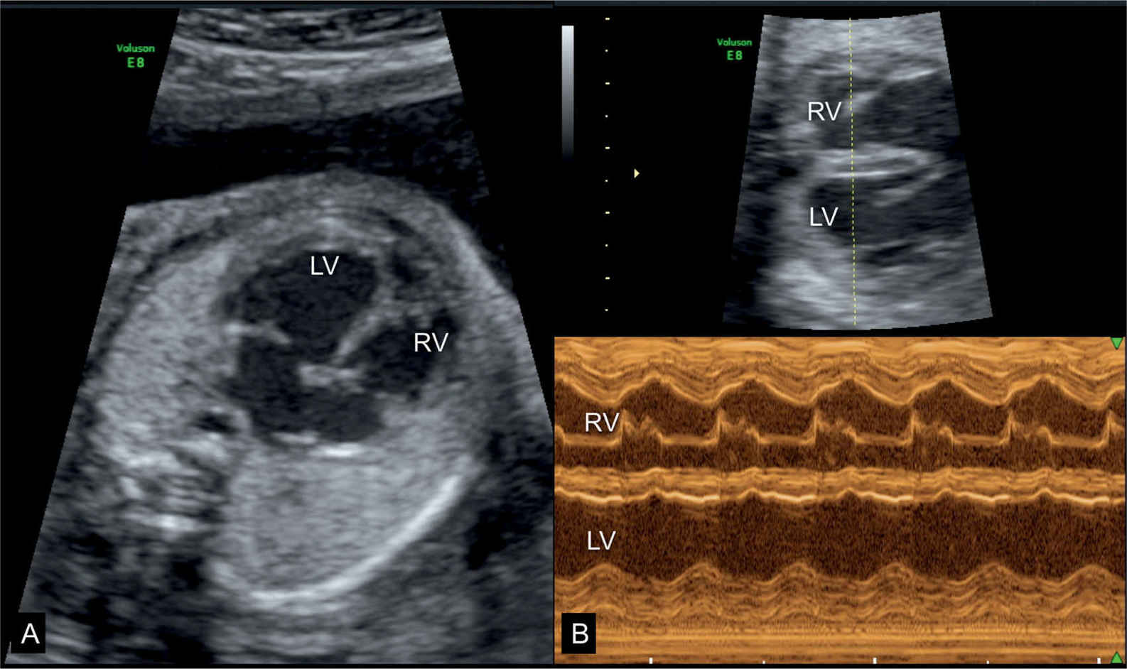 Fetal Cardiomyopathies and Fetal Heart Tumors Obgyn Key