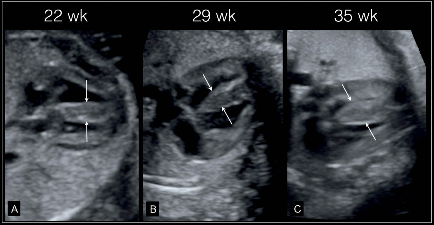 Fetal Cardiomyopathies and Fetal Heart Tumors Obgyn Key