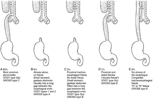 Esophageal Atresia and Tracheoesophageal Fistula Obgyn Key