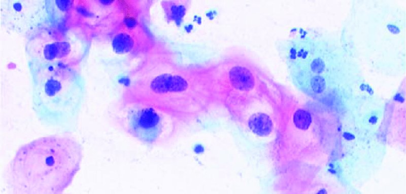 Cytology and screening for cervical precancer Obgyn Key