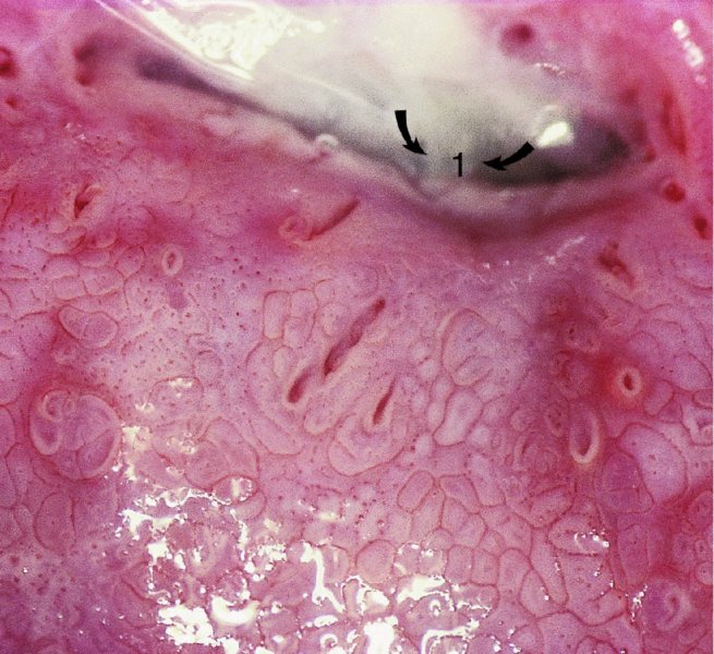 White Lesions On Cervix
