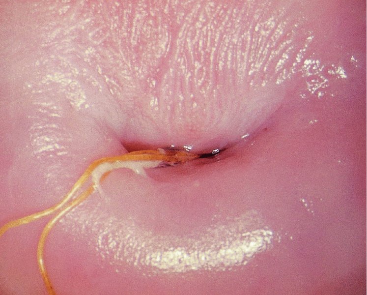 How to know if cervix is open