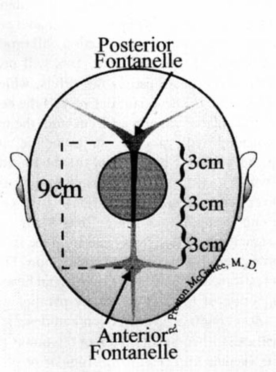 Operative Delivery by Vacuum Obgyn Key