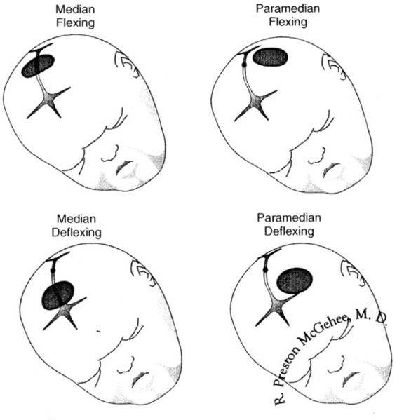 Vacuum Delivery Placement