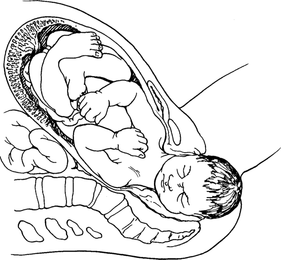 Suprapubic Pressure Shoulder Dystocia